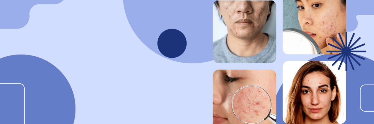 acne_module_banner